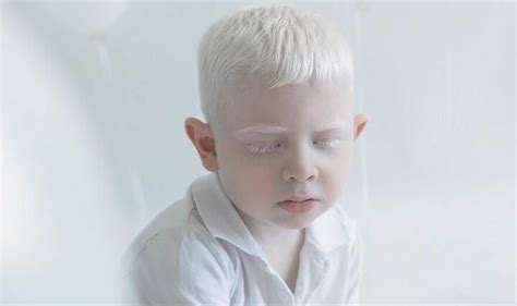 albino belirtileri